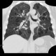 Lymphocytic interstitial pneumonia, cystic lung disease: CT - Computed tomography